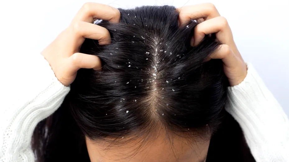 Remedii naturale eficiente împotriva mătreții