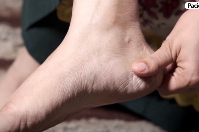 Călcâiele crăpate: soluții simple acasă și ce afecțiuni pot ascunde