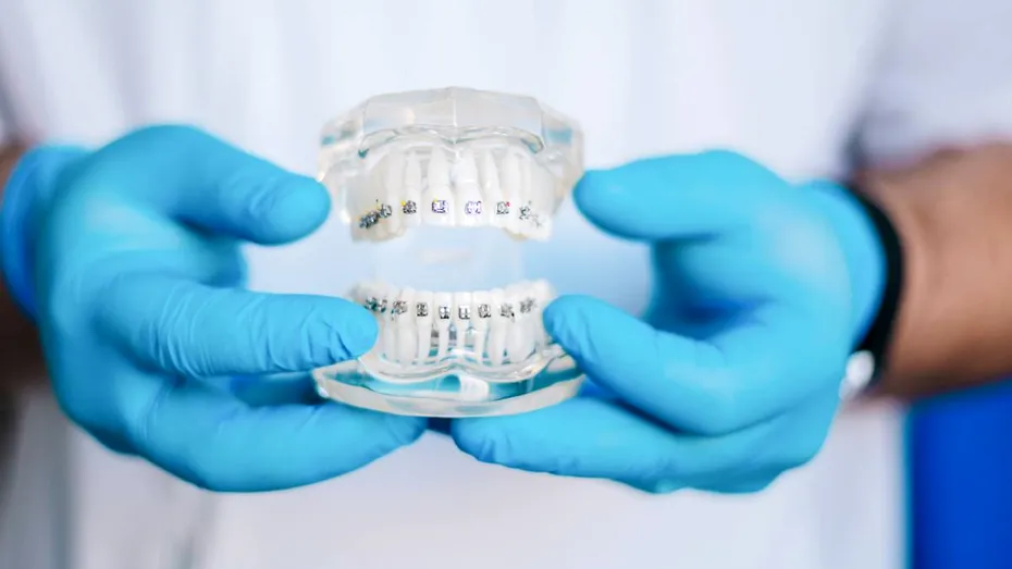 Ce legătură are tipul de bracket cu fixarea pe dinte și cum influențează tratamentul ortodontic